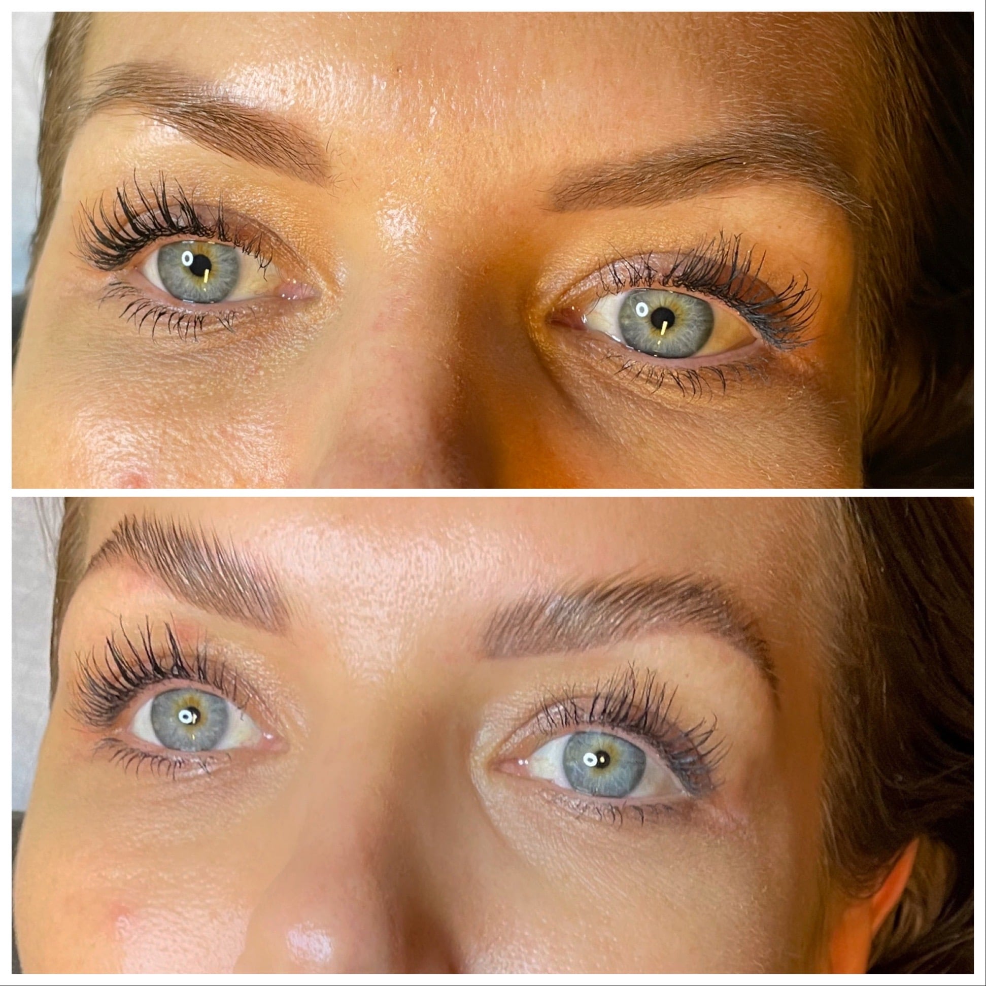 Brow lift århus